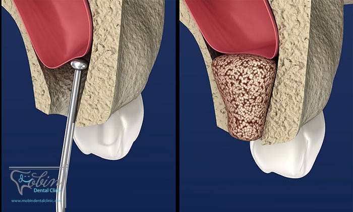 قبل و بعد از پیوند استخوان دندان